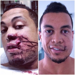 O antes e o depois de Giancarlo Stanton após a bolada. Apesar da recuperação, ele precisará de mais tempo (Foto: Reprodução Instagram)