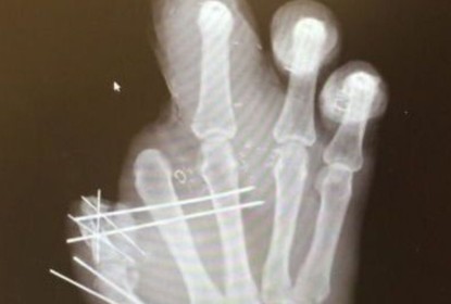 Jason Pierre-Paul compartilha raio X de sua mão deformada - The Playoffs